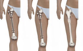 AFA Limb Lengthening — clinic photo — photo 8