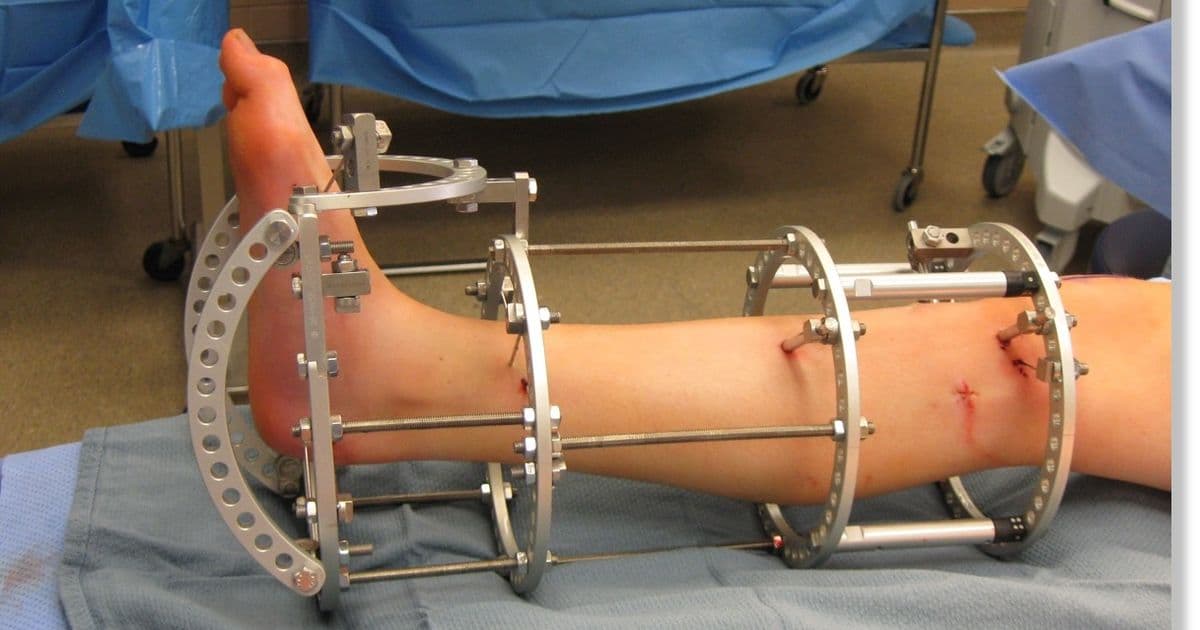 Height Lengthening — clinic photo — photo 2