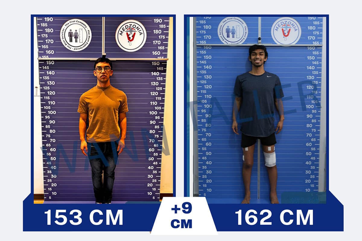 Height Lengthening — clinic photo — photo 3