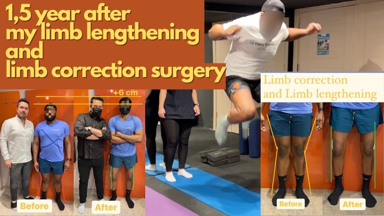1,5 year after my limb lengthening and limb correction surgery ...